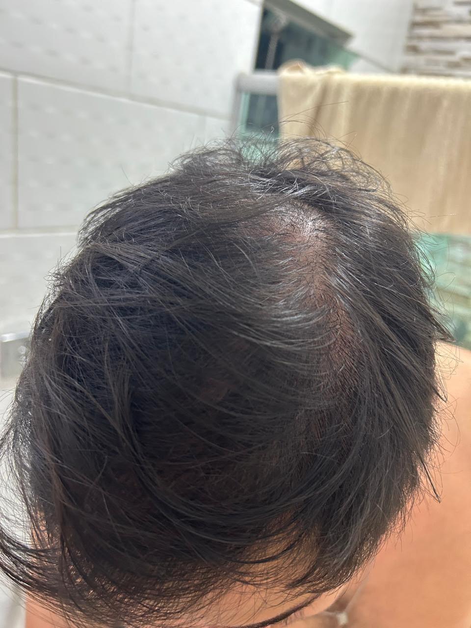 Coroa com rarefação antes do tratamento com Baican