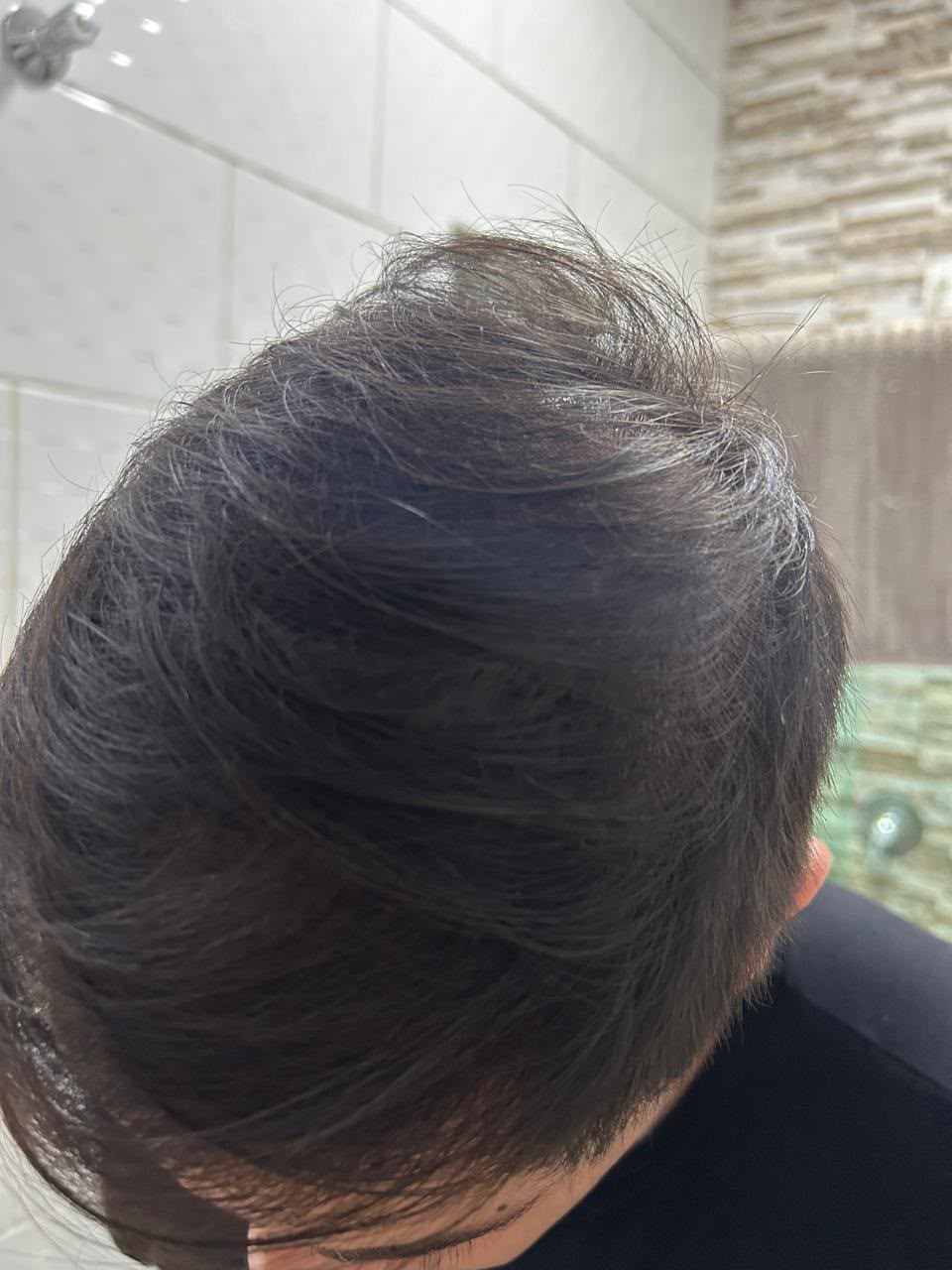Coroa visivelmente mais preenchida depois do tratamento com Baican